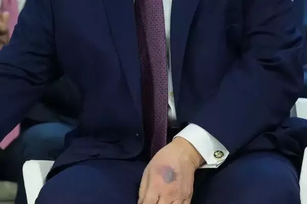 Trump Explains Hand Bruise Amid Health Speculation