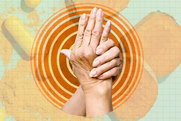 Dietary Strategies to Mitigate Arthritis Flare-Ups