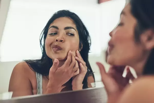 Understanding and Managing Postpartum Acne