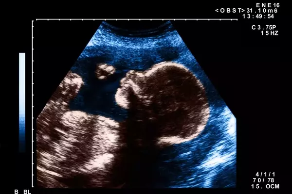 The Art and Impact of Pregnancy Nicknames