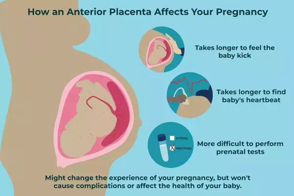 Understanding Anterior Placenta During Pregnancy